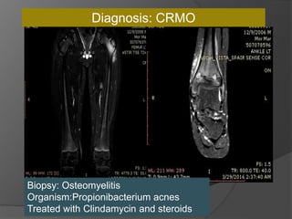 Biopsy: Osteomyelitis
Organism:Propionibacterium acnes
Treated with Clindamycin and steroids
Diagnosis: CRMO
 