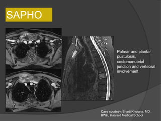 SAPHO
Palmar and plantar
pustulosis,
costomanubrial
junction and vertebral
involvement
Case courtesy: Bharti Khurana, MD
BWH, Harvard Medical School
 