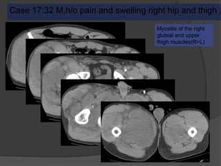 Case 17:32 M,h/o pain and swelling right hip and thigh
Myositis of the right
gluteal and upper
thigh muscles(R>L)
 
