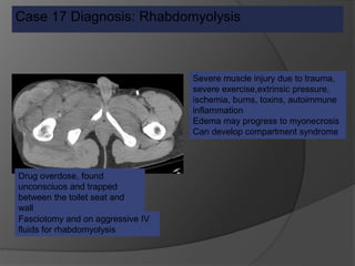 Case 17 Diagnosis: Rhabdomyolysis
Severe muscle injury due to trauma,
severe exercise,extrinsic pressure,
ischemia, burns, toxins, autoimmune
inflammation
Edema may progress to myonecrosis
Can develop compartment syndrome
Fasciotomy and on aggressive IV
fluids for rhabdomyolysis
Drug overdose, found
unconsciuos and trapped
between the toilet seat and
wall
 
