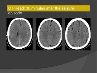CT Head: 30 minutes after the seizure
episode
 