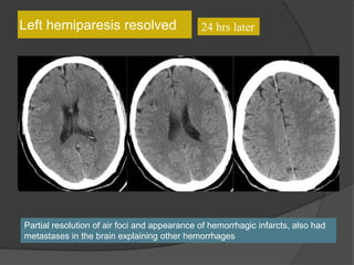 24 hrs laterLeft hemiparesis resolved
Partial resolution of air foci and appearance of hemorrhagic infarcts, also had
metastases in the brain explaining other hemorrhages
 
