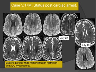 Case 5:17M, Status post cardiac arrest:
July 22
July 16
Bilateral parietal white matter diffusion restriction
and ADC hypointensity
 