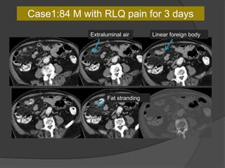 Case1:84 M with RLQ pain for 3 days
Linear foreign bodyExtraluminal air
Fat stranding
 