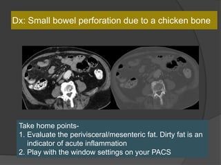 Dx: Small bowel perforation due to a chicken bone
Take home points-
1. Evaluate the perivisceral/mesenteric fat. Dirty fat is an
indicator of acute inflammation
2. Play with the window settings on your PACS
 