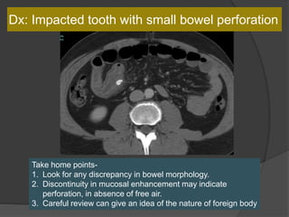 Dx: Impacted tooth with small bowel perforation
Take home points-
1. Look for any discrepancy in bowel morphology.
2. Discontinuity in mucosal enhancement may indicate
perforation, in absence of free air.
3. Careful review can give an idea of the nature of foreign body
 