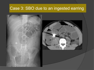Case 3: SBO due to an ingested earring
 