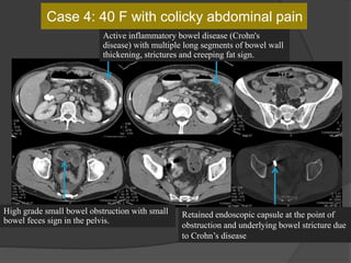 Case 4: 40 F with colicky abdominal pain
High grade small bowel obstruction with small
bowel feces sign in the pelvis.
Retained endoscopic capsule at the point of
obstruction and underlying bowel stricture due
to Crohn’s disease
Active inflammatory bowel disease (Crohn's
disease) with multiple long segments of bowel wall
thickening, strictures and creeping fat sign.
 