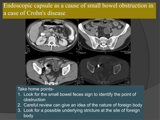Endoscopic capsule as a cause of small bowel obstruction in
a case of Crohn's disease
Take home points-
1. Look for the small bowel feces sign to identify the point of
obstruction
2. Careful review can give an idea of the nature of foreign body
3. Look for a possible underlying stricture at the site of foreign
body
 