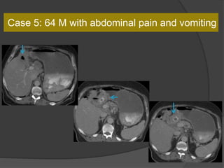 Case 5: 64 M with abdominal pain and vomiting
 