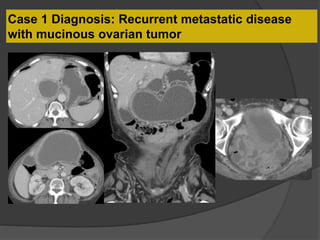 Case 1 Diagnosis: Recurrent metastatic disease
with mucinous ovarian tumor
 