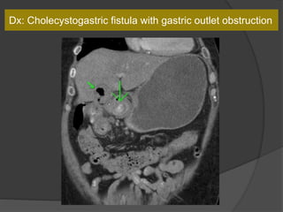 Dx: Cholecystogastric fistula with gastric outlet obstruction
 