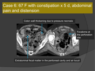 Extraluminal fecal matter in the peritoneal cavity and air loculi
Fecaloma at
the perforation
site
Colon wall thickening due to pressure necrosis
Case 6: 67 F with constipation x 5 d, abdominal
pain and distension
 