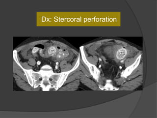 Dx: Stercoral perforation
 