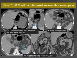 Cecum in the lesser sac
Cecum mildly dilatedCecum in the lesser sac between
the liver hilum and IVC
No twist to indicate cecal volvulus
Case 7: 38 M with acute onset severe abdominal pain
 