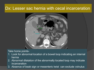 Dx: Lesser sac hernia with cecal incarceration
Take home points-
1. Look for abnormal location of a bowel loop indicating an internal
hernia
2. Abnormal dilatation of the abnormally located loop may indicate
incarceration
3. Absence of beak sign or mesenteric twist can exclude volvulus
 