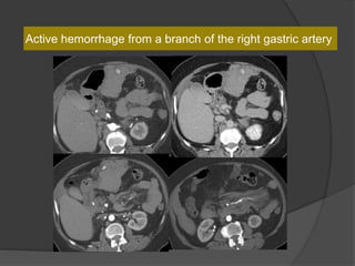 Active hemorrhage from a branch of the right gastric artery
 