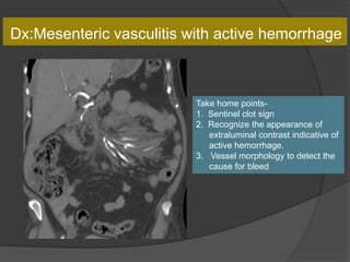 Dx:Mesenteric vasculitis with active hemorrhage
Take home points-
1. Sentinel clot sign
2. Recognize the appearance of
extraluminal contrast indicative of
active hemorrhage.
3. Vessel morphology to detect the
cause for bleed
 