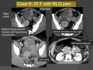 Bilateral large adnexal
masses with hyperdense
components.
Right
ovary
Left ovary
Free fluid
Uterine deviation to the right
Case 9: 25 F with RLQ pain
Soft tissue deposit
 