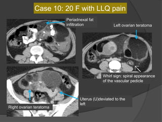 Case 10: 20 F with LLQ pain
Whirl sign: spiral appearance
of the vascular pedicle
Periadnexal fat
infiltration
Uterus (U)deviated to the
left
U
Right ovarian teratoma
Left ovarian teratoma
 