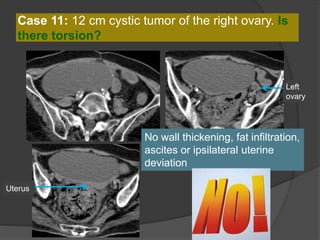 Case 11: 12 cm cystic tumor of the right ovary. Is
there torsion?
No wall thickening, fat infiltration,
ascites or ipsilateral uterine
deviation
Left
ovary
Uterus
 