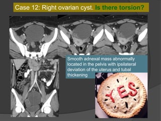 Case 12: Right ovarian cyst. Is there torsion?
Smooth adnexal mass abnormally
located in the pelvis with ipsilateral
deviation of the uterus and tubal
thickening
 
