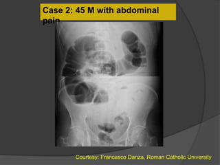 Case 2: 45 M with abdominal
pain
Courtesy: Francesco Danza, Roman Catholic University
 