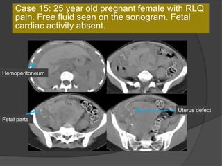 Case 15: 25 year old pregnant female with RLQ
pain. Free fluid seen on the sonogram. Fetal
cardiac activity absent.
Hemoperitoneum
Fetal parts
Uterus defect
 