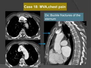Case 18: MVA,chest pain
Dx: Buckle fractures of the
sternum
 