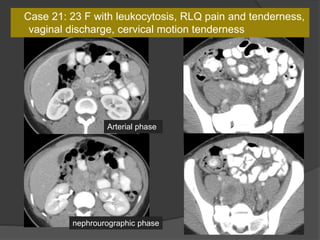 Case 21: 23 F with leukocytosis, RLQ pain and tenderness,
vaginal discharge, cervical motion tenderness
Arterial phase
nephrourographic phase
 