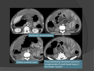Peritoneal carcinomatosis
Thick enhancing membrane around a
conglomerate of small bowel loops in
the center “cocoon”
Dilated proximal colon
 