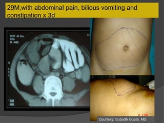 29M,with abdominal pain, bilious vomiting and
constipation x 3d
Courtesy: Subodh Gupta, MS
 