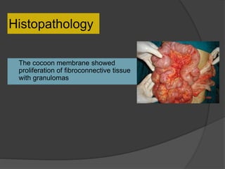 Histopathology
 The cocoon membrane showed
proliferation of fibroconnective tissue
with granulomas
 