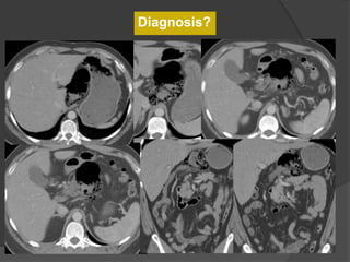 Cecum in the lesser sac
Diagnosis?
 