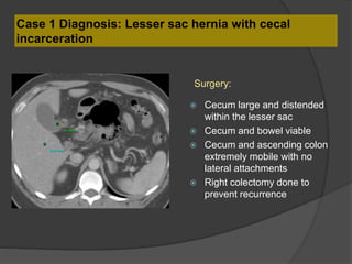 Case 1 Diagnosis: Lesser sac hernia with cecal
incarceration
 Cecum large and distended
within the lesser sac
 Cecum and bowel viable
 Cecum and ascending colon
extremely mobile with no
lateral attachments
 Right colectomy done to
prevent recurrence
Surgery:
 