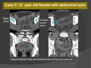 Case 2: 12 year old female with abdominal pain
Dilated fallopian tube with thickened and enhancing tubal wall
Right
ovary
Complex
tubular
mass
 