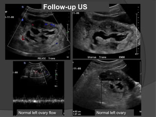 Follow-up US
Normal left ovaryNormal left ovary flow
 