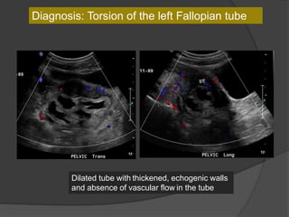Diagnosis: Torsion of the left Fallopian tube
Dilated tube with thickened, echogenic walls
and absence of vascular flow in the tube
 