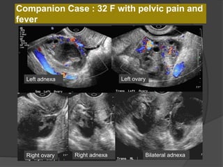 Companion Case : 32 F with pelvic pain and
fever
Left ovaryLeft adnexa
Right ovary Right adnexa Bilateral adnexa
 