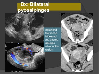 Dx: Bilateral
pyosalpinges
Increased
flow in the
thickened
and dilated
fallopian
tubes unlike
torsion
 