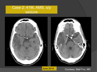 June 2014
Case 2: 41M, AMS, s/p
seizure
Courtesy: Matt Fox, MD
 