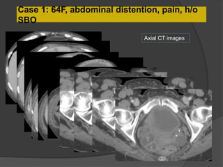 Case 1: 64F, abdominal distention, pain, h/o
SBO
Axial CT images
 