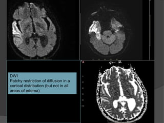 DWI Flair
ADC
DWI
Patchy restriction of diffusion in a
cortical distribution (but not in all
areas of edema)
 