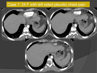 Case 1: 24 F with left sided pleuritic chest pain
 