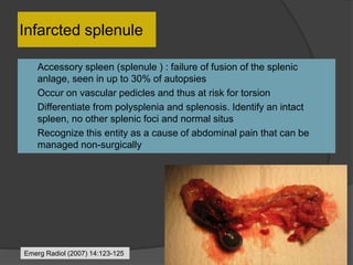 Infarcted splenule
 Accessory spleen (splenule ) : failure of fusion of the splenic
anlage, seen in up to 30% of autopsies
 Occur on vascular pedicles and thus at risk for torsion
 Differentiate from polysplenia and splenosis. Identify an intact
spleen, no other splenic foci and normal situs
 Recognize this entity as a cause of abdominal pain that can be
managed non-surgically
Emerg Radiol (2007) 14:123-125
 