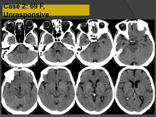 Case 2: 69 F,
Unresponsive
 