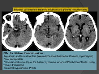 Bilateral paramedian thalamic, midbrain and pontine hypodensities
DDx for bilateral thalamic lesions:
•Metabolic and toxic disorders (Wernicke’s encephalopathy, Osmotic myelinolysis)
•Viral encephalitis
•Vascular occlusion-Top of the basilar syndrome, Artery of Percheron infarcts, Deep
venous thrombosis
•Cerebral hypotension, PRES
 
