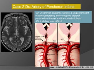 Lazzaro N et al. AJNR Am J Neuroradiol 2010;31:1283-1289
•An uncommon anatomic variant: a single dominant
thalamoperforating artery supplies bilateral
paramedian thalami and the rostral midbrain
•Clinical diagnosis difficult
Case 2 Dx: Artery of Percheron Infarct
 