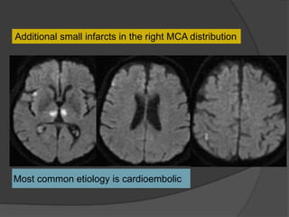 Most common etiology is cardioembolic
Additional small infarcts in the right MCA distribution
 