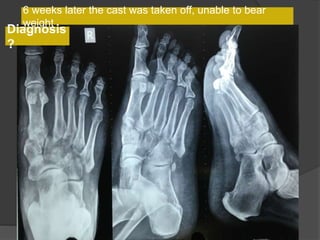 6 weeks later the cast was taken off, unable to bear
weight
Diagnosis
?
 